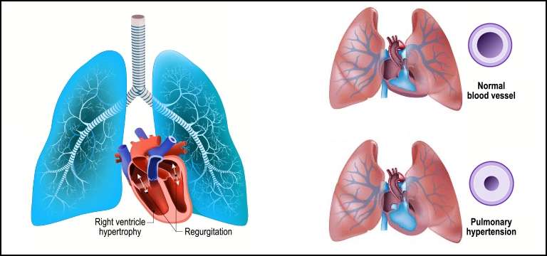 Pulmonary Hypertension : A Comprehensive Guide to Understanding and Managing the Condition